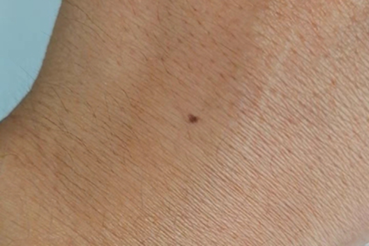 黑素细胞痣手背黑斑图