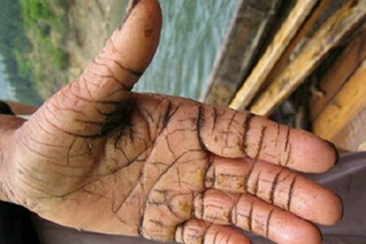 板层状鱼鳞病手掌裂纹图