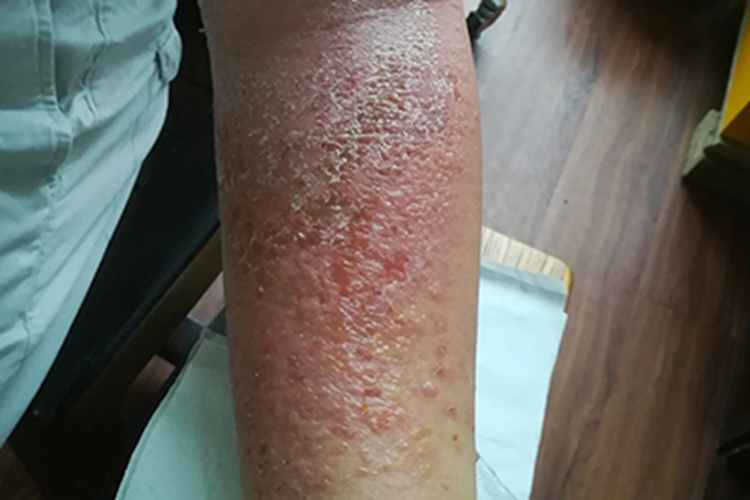 亚急性湿疹手臂小水疱图