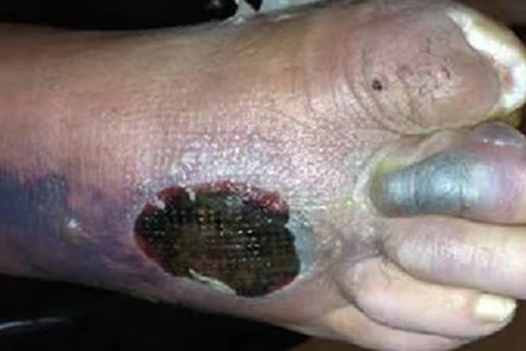 湿性坏疽脚背溃烂发紫图