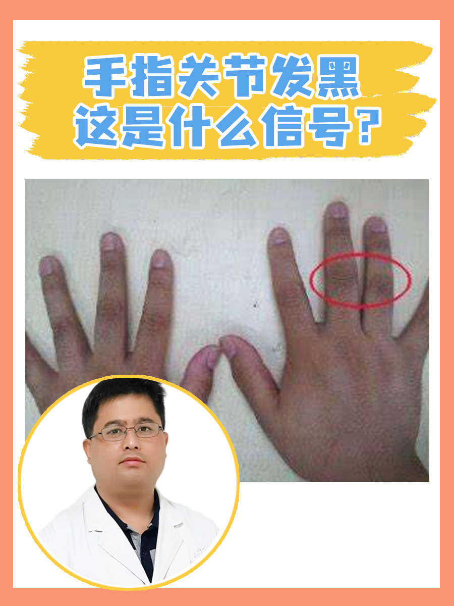 手指关节发黑,这是什么信号?