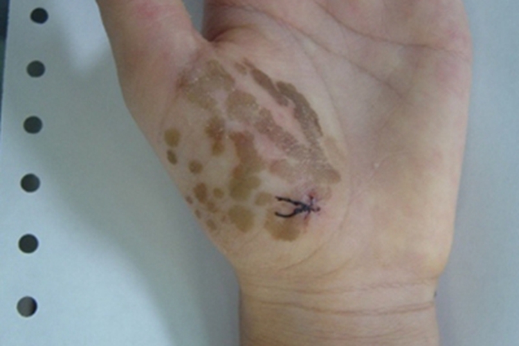 掌黑癣手掌有褐色斑片图 掌黑癣手掌有褐色斑片图