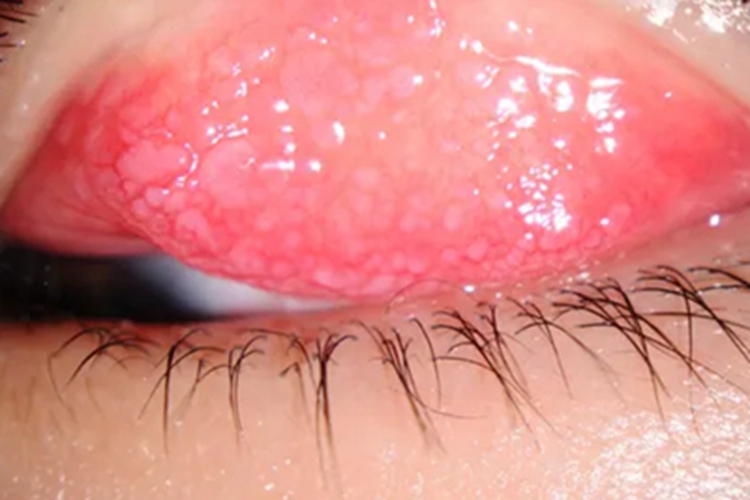 巨乳头性结膜炎小疙瘩图