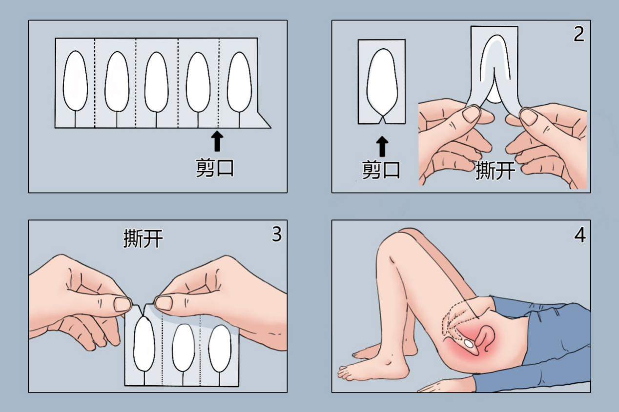 妇科塞药怎么塞图解图片