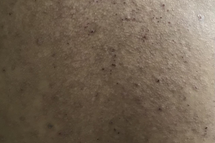 慢性湿疹背部血痂图 慢性湿疹背部血痂图