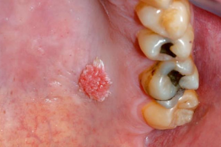 口腔上颚鳞状乳头状瘤图