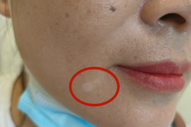 进展期节段型白癜风口周白点图