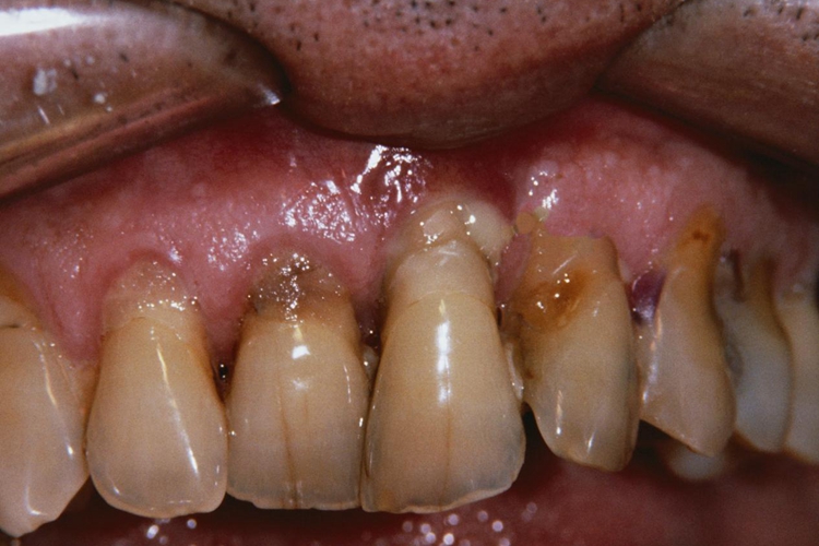 血卟啉病牙齿图