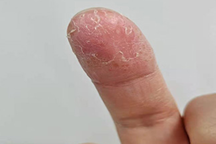 手指头湿疹脱皮图 手指头湿疹脱皮图