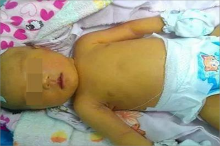 新生儿病理性黄疸全身症状图 新生儿病理性黄疸全身症状图