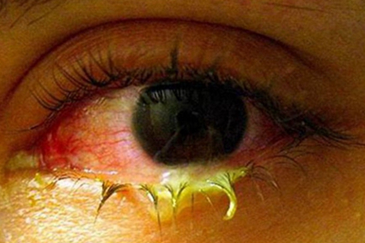 急性或亚急性细菌性结膜炎化脓图