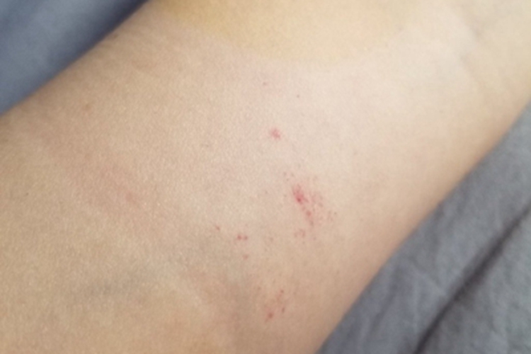 血管内压力增多性紫癜胳膊症状图 血管内压力增多性紫癜胳膊症状图