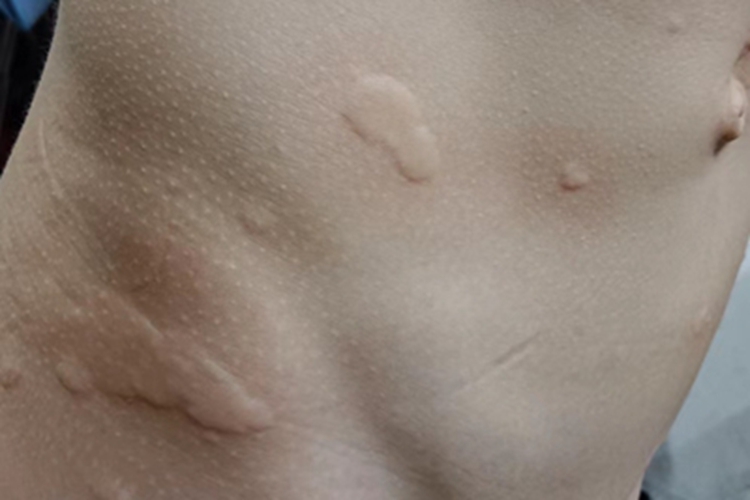 慢性自发性荨麻疹腰部症状图