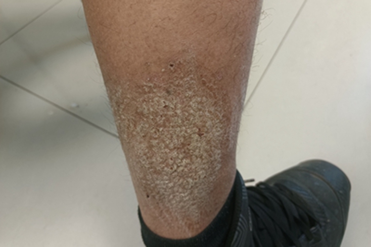 皮肤淀粉样变脱屑图 皮肤淀粉样变脱屑图