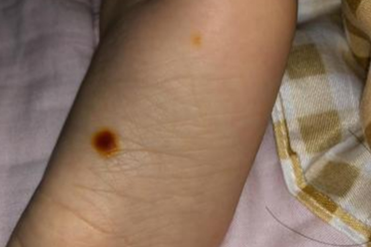 散在的黄点或者黄斑图 散在的黄点或者黄斑图