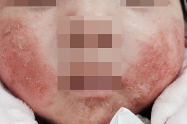 婴儿期特应性皮炎面部症状图 婴儿期特应性皮炎面部症状图
