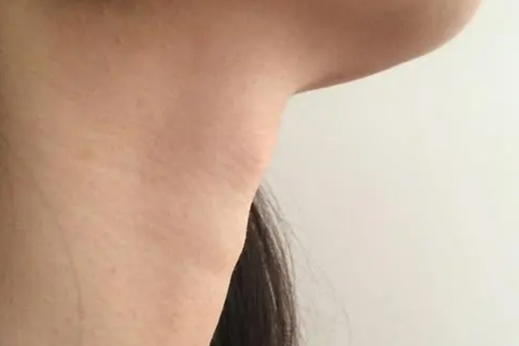 女性青少年正常的喉结图