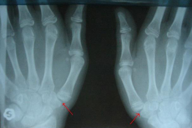 第一腕掌关节脱位图