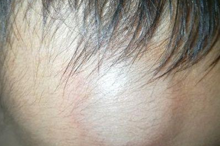 婴儿前额皮下血肿局部突出图 婴儿前额皮下血肿局部突出图