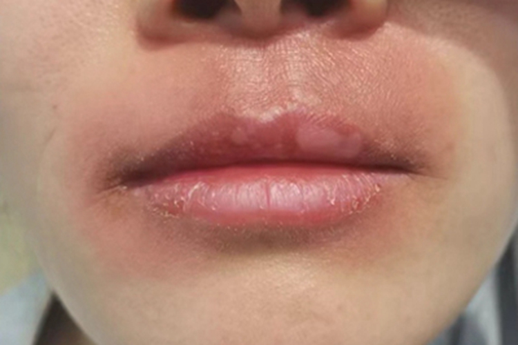 唇炎嘴唇红肿图