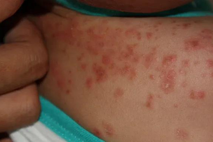 男性大腿根部急性湿疹图