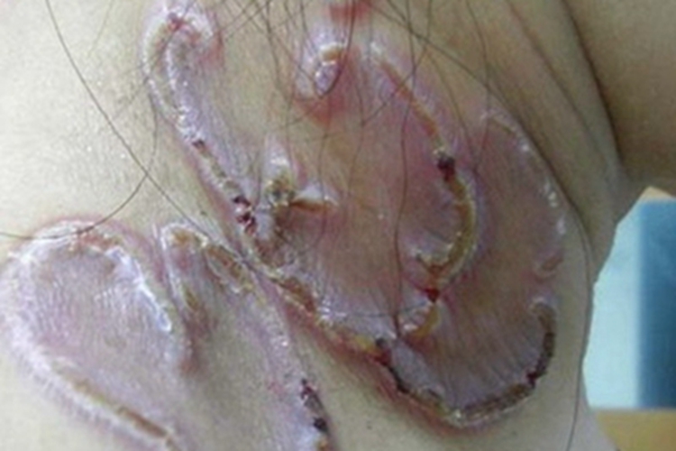 女性三期梅毒颈部结痂图