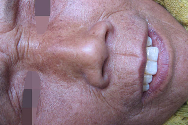 系统性硬皮病色素沉着图 系统性硬皮病色素沉着图