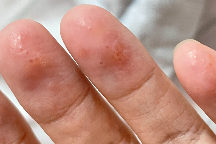 汗疱疹手指尖小疙瘩图