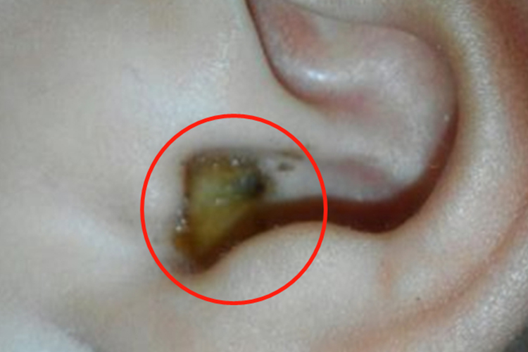 慢性化脓性中耳炎图