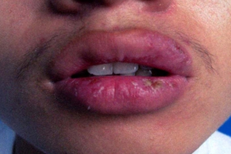 腺性唇炎嘴唇变肿图