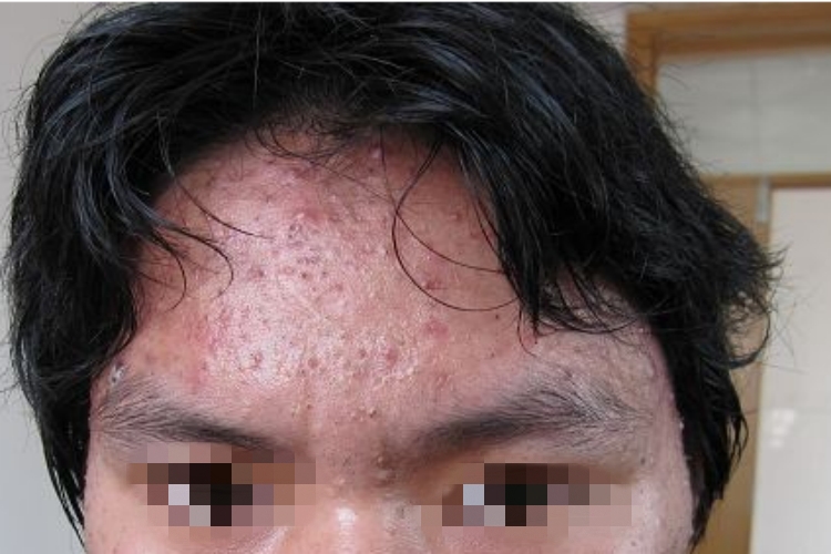 聚合性痤疮面部黑头粉刺图 聚合性痤疮面部黑头粉刺图