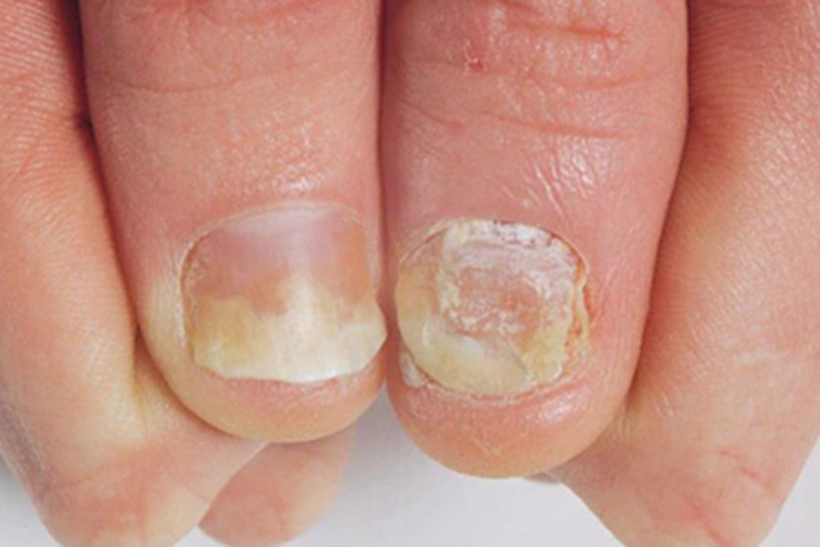 银屑病甲手指甲白斑图 银屑病甲手指甲白斑图