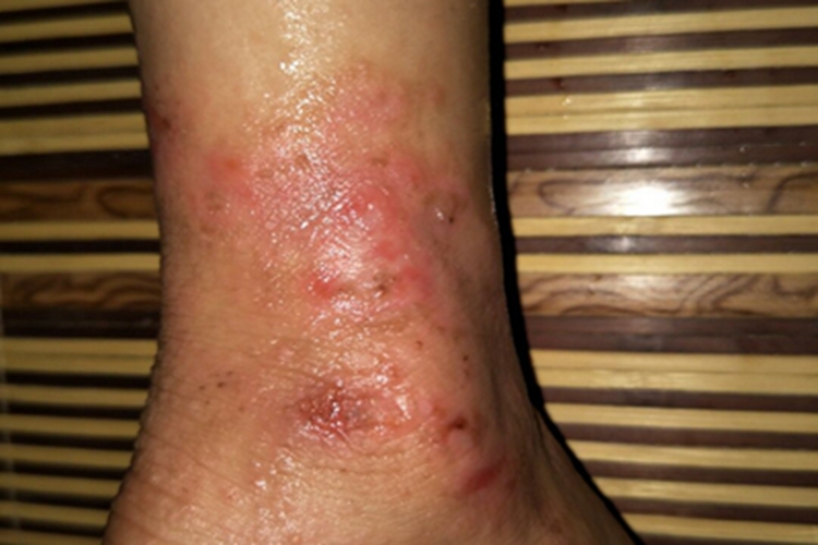 职业性光毒性接触性皮炎水疱图