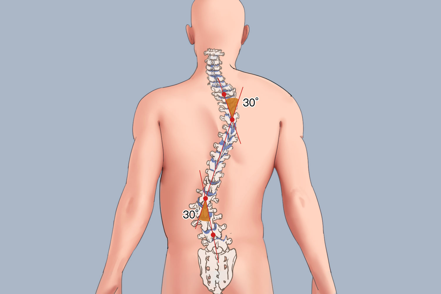 S型脊柱侧弯图<br />
