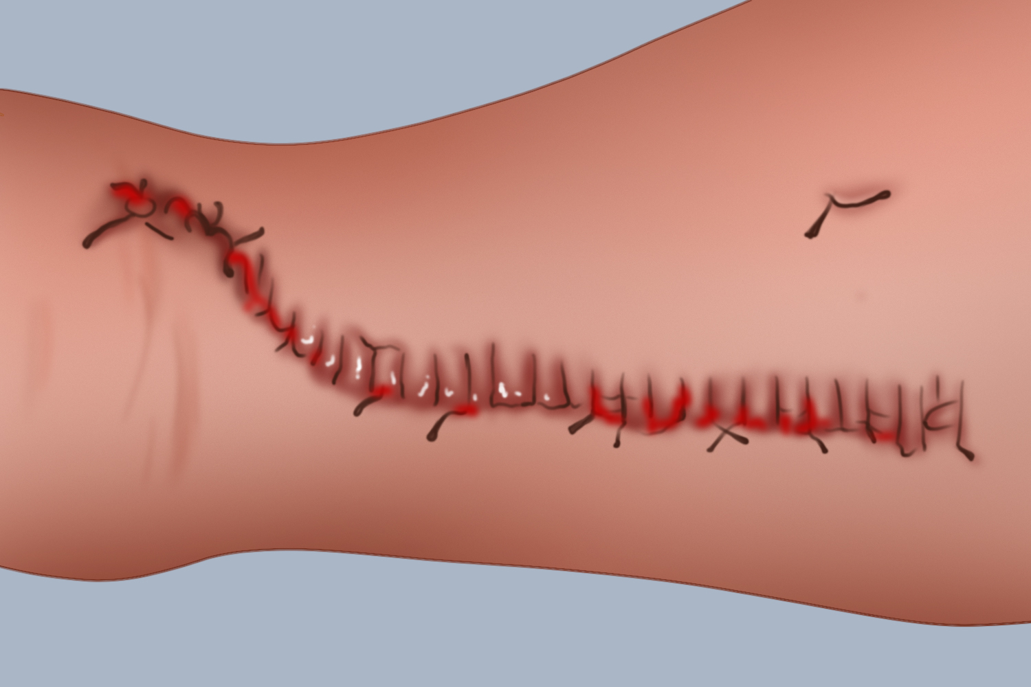 跟腱手术伤口出血不愈合图