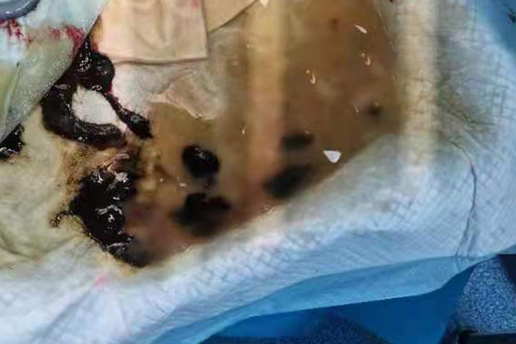  胎膜早破带有胎粪的液体图