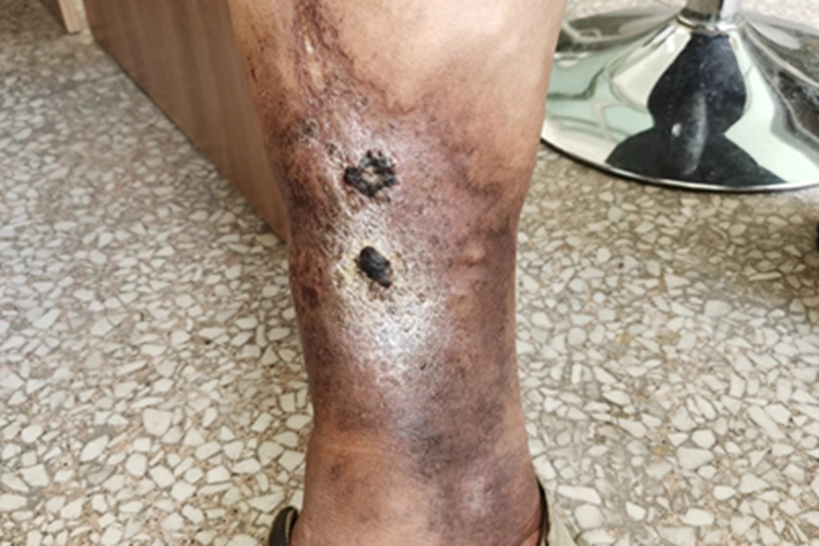 臁疮小腿症状图 臁疮小腿症状图