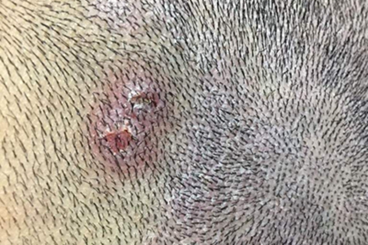 头皮糠疹头皮疙瘩图