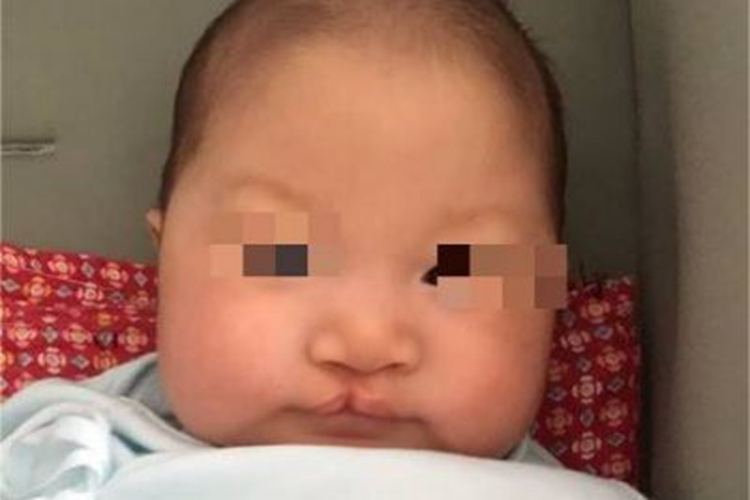 Ⅰ度唇裂嘴唇症状图