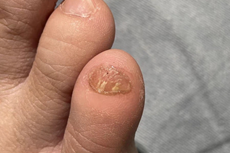 全甲损毁型甲真菌病脚趾甲发黄图 全甲损毁型甲真菌病脚趾甲发黄图