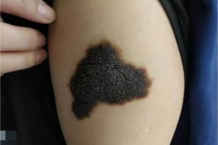 恶性雀斑样痣胳膊症状图