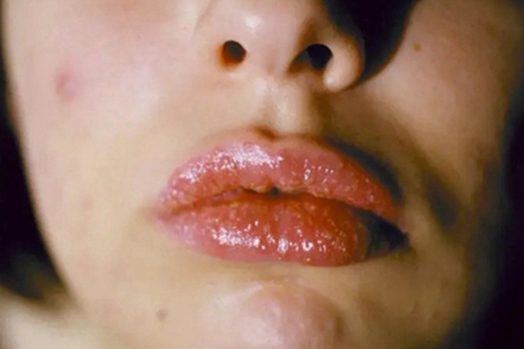 过敏性接触性口炎嘴唇红肿图
