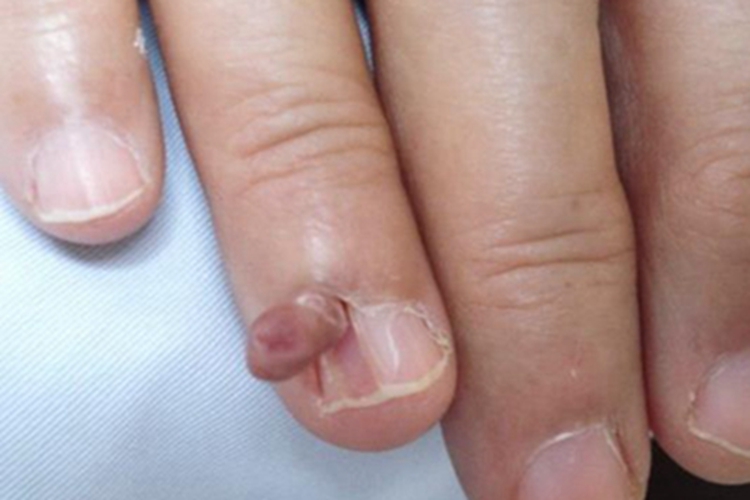 皮肤纤维瘤手指甲结节图