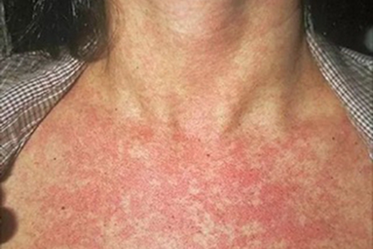 轻型麻疹胸部症状图