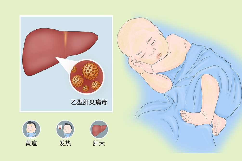 新生儿乙型肝炎