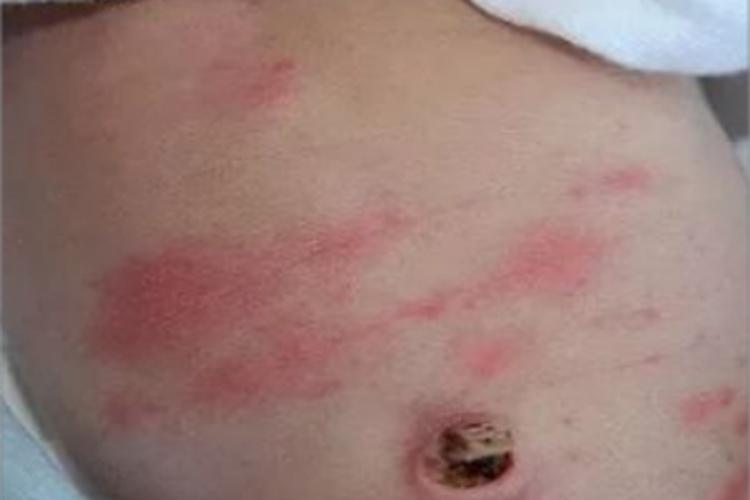 毒性红斑腹部症状图