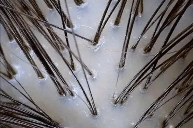 健康头皮毛囊检测图