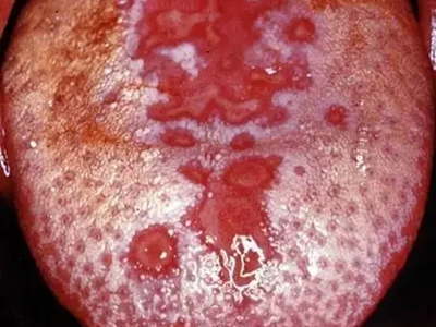 二期口腔梅毒舌头发白有一块一块红斑图.jpg