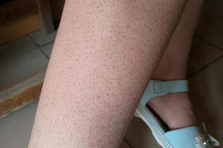 毛发苔藓小腿斑图