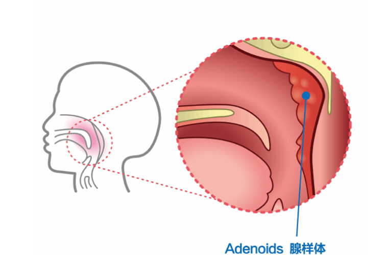 腺样体肥大图